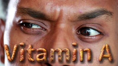 Vitamin A.