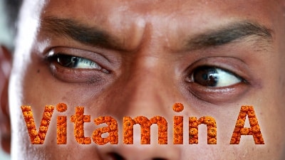 Vitamin A.